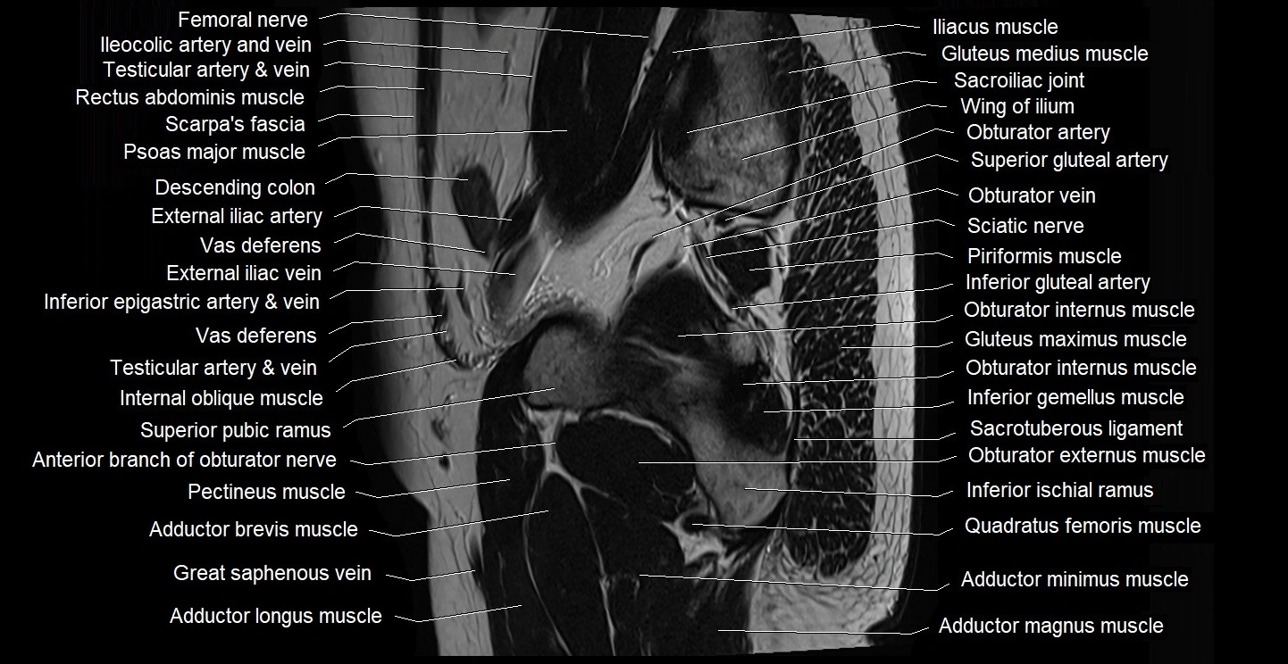 male pelvis sagittal cross sectional anatomy 3T mri image 8.webp